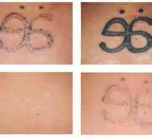 Kako se znebiti napak iz preteklosti: Laser Tattoo Removal